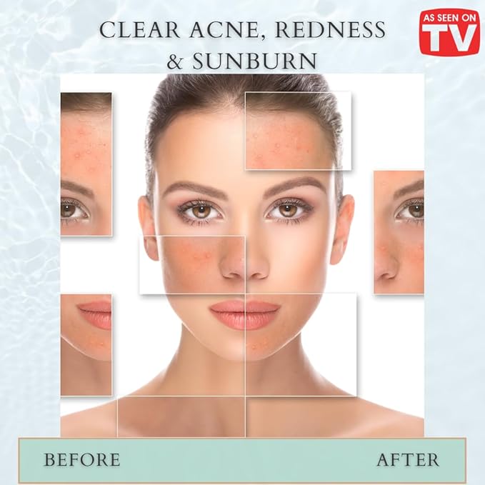 VoilaVe Pure Hypochlorous Acid Spray, All-in-One Skin Spray for Every Skin Type | HOCL Spray | Supports Acne, Scraps, Bruises, Rashes, Piercings, Tattoos, and Odors | Multi-Purpose Cleaner Spray 8 Oz