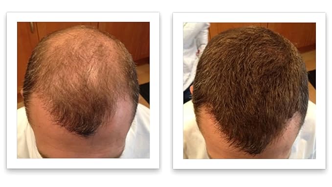 Thinning Hair Solution - All-Natural, Plant-Based Fibers For Fuller, Thicker Appearance. Instantly Covers Bald Spots. Auburn (red/ginger hair). Trial Size, 10-Day Supply