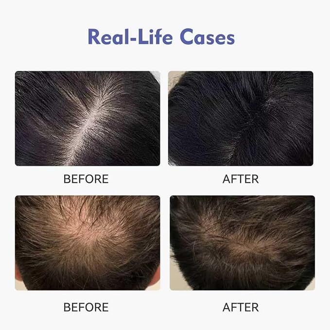 KINTOR 0.9% KX-826 DHT Blocker for Men & Women Hair Growth,Hair Growth Products Foam 120ml Pro