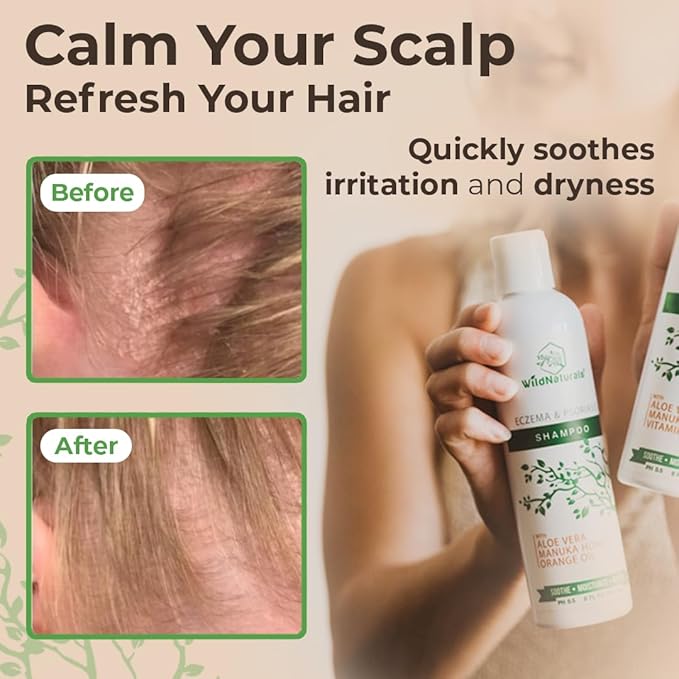 Wild Naturals Eczema & Psoriasis Shampoo – Anti-Dandruff Relief for Dry, Itchy Scalp – Hypoallergenic, Fragrance-Free Formula for Sensitive Scalp
