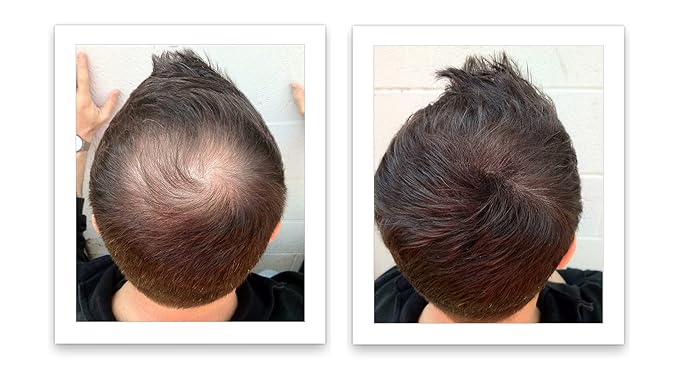 Hair Loss Concealer. Cover Bald Spot and Thinning Hair Instantly. Make Thin Hair Look 10X Fuller. All-Natural Hair Building Fiber. Trial Size (10-Day Supply). Dark Brown