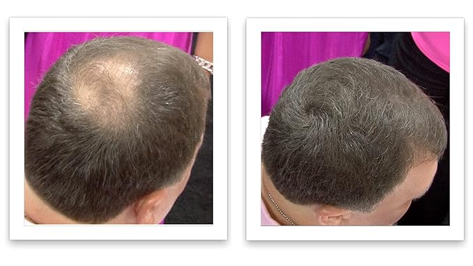 Hair Building Fiber. Cover Bald Spot and Thinning Hair Instantly. 10X Fuller Hair. All-Natural, Organic Hair Loss Concealer. Trial Size (10-Day Supply). Medium Brown