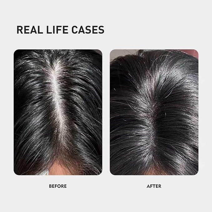 KINTOR 0.9% KX-826 DHT Blocker for Men & Women Hair Growth,Hair Growth Products Spray 60ml Pro