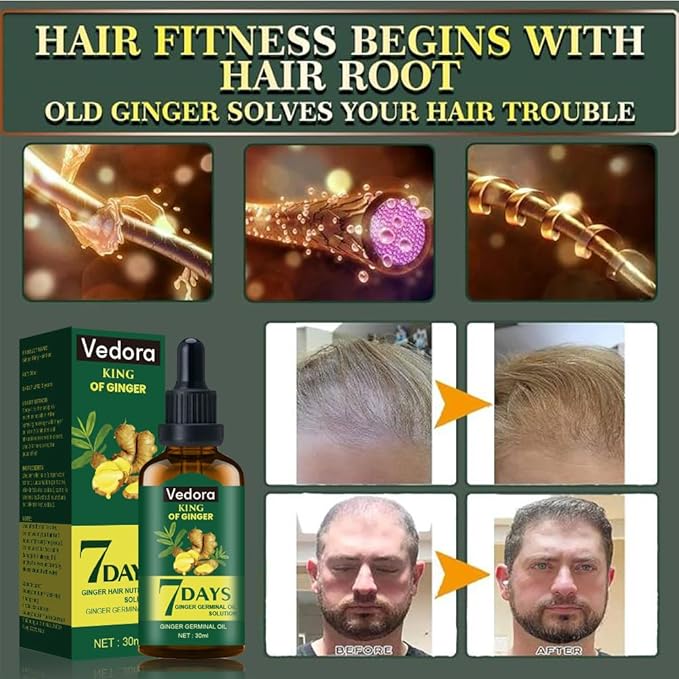 Vedora King of Ginger Oil for Hair Growth - Biotin Hair Growth Serum, 100% Pure Natural Ginger Essential Oil - Promotes Stronger, Thicker, Longer Hair in Women & Men - 3.15 Fl Oz / 90ML (3 PCS)