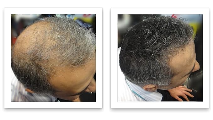 Trial Size - Eliminate Bald Spot and Thinning Hair Instantly. Make Thin Hair Look 10X Fuller. All-Natural Hair Thickening Fiber. Salt & Pepper - Dark