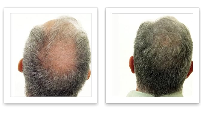 Hair Fibers For Hair Loss. Cover Bald Spot and Thinning Hair Instantly. Make Thin Hair Look 10X Fuller. All-Natural Hair Building Fiber. Trial Size (10-Day Supply). Dark Gray