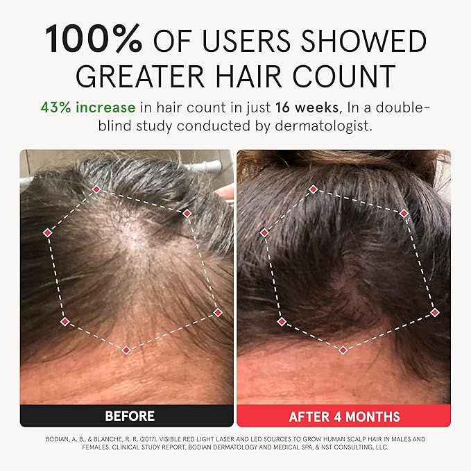 iRestore Elite + Rechargeable Battery Pack - Laser Red Light Therapy for Hair Growth - FDA Cleared Hair Loss, Hair Thinning Treatment for Men & Women - Hair Regrowth Laser Cap - 500 Lasers & LEDs