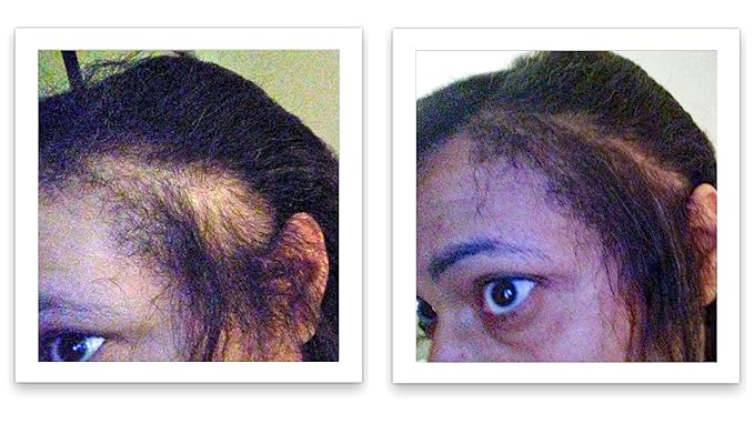 Hair Powder For Thinning Hair. Makes Thin Hair Look 10X Fuller, Covers Bald Spot Instantly. All-Natural Hair Building Fiber. Trial Size (10-Day Supply). Black