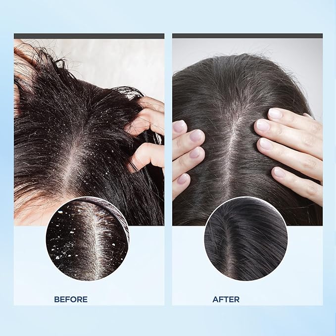 Bablabear Scalp Exfoliator Scrub,Itchy Scalp Treatment for Dandruff, No Sulfate Hair Scrub To Soothe a Dry, Flaky,Scalp,Removes Buildup,Clarifying Shampoo.