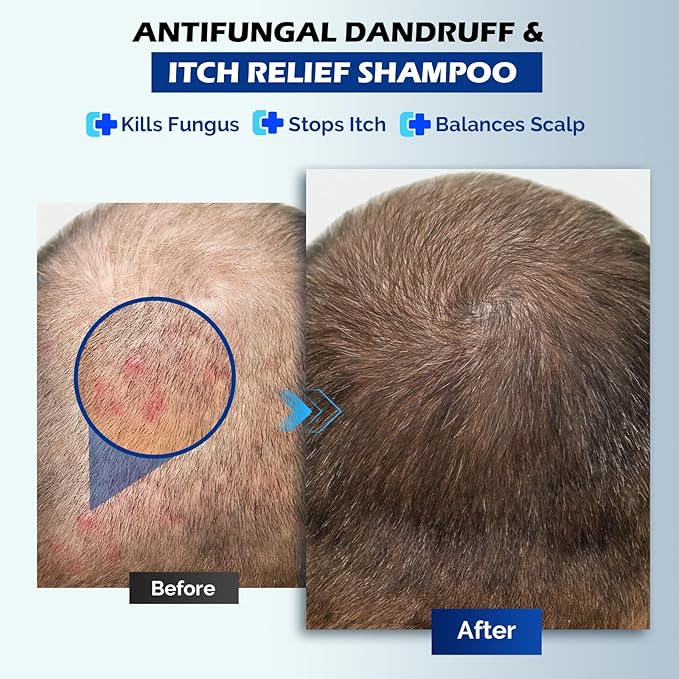 Antifungal Shampoo for Seborrheic Dermatitis, Folliculitis & Scalp Psoriasis, Anti-Dandruff Shampoo for Men & Women, Relieves Scalp Itching, Dryness, Sulfate & Paraben-Free, 10.1 Fl Oz-Fresh