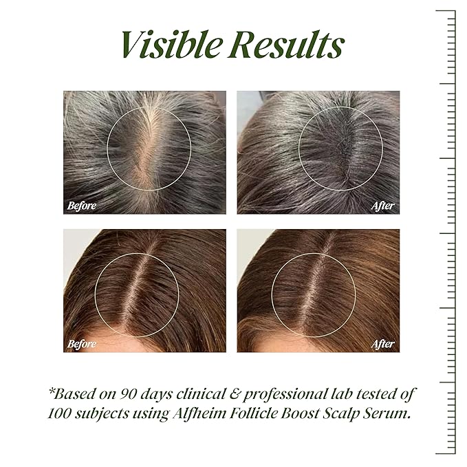ALFHEIM Saw Palmetto Scalp Serum to Strengthen Follicles | With Caffeine & Biotin for Fuller Hair | Helps Balance Scalp, Revive Hair Roots & Enhance Hair Density | 0.34 fl oz + Serum Applicator