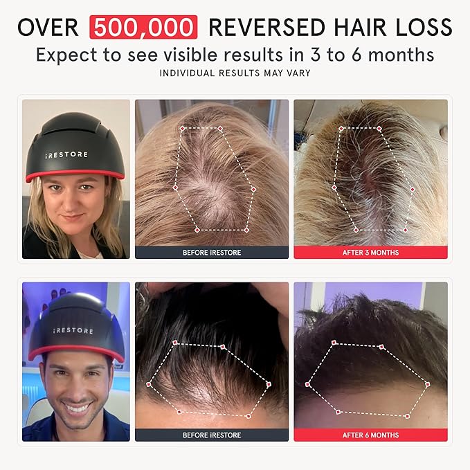 iRestore Elite + Rechargeable Battery Pack - Laser Red Light Therapy for Hair Growth - FDA Cleared Hair Loss, Hair Thinning Treatment for Men & Women - Hair Regrowth Laser Cap - 500 Lasers & LEDs