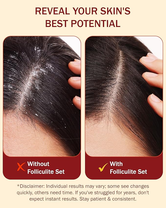 Folliculitis 3-Piece Set - Folliculitis Shampoo, Dry Scalp Serum & Body Spray with Salicylic Acid, Tea Tree Oil & Peppermint Oil - Soothes Itchy Scalp, Razor Bumps & Blemishes by e70