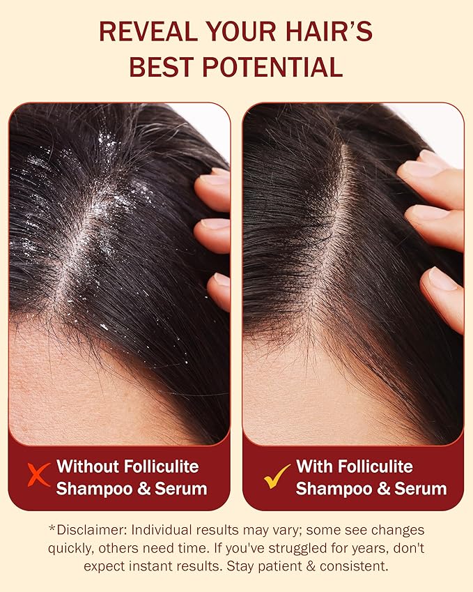 Folliculitis Treatment Shampoo & Serum with 3% BHA, Salicylic Acid, Tea Tree Oil & Chamomile Extracts - Anti Itch Shampoo for women & men with Flaky Scalp Treatment Acne, Made in USA by e70, 8 fl oz